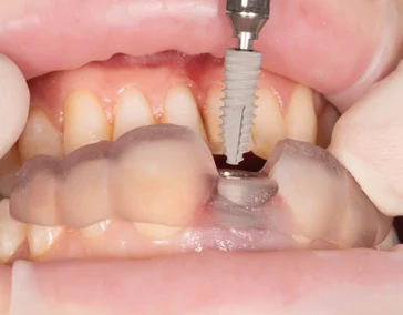 Одиночный имплантат